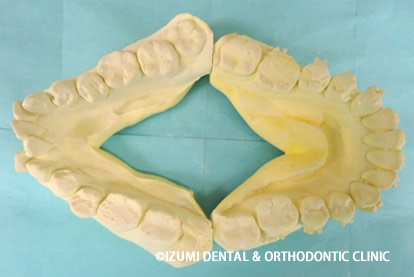 顎のアーチ模型