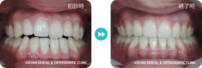 反対咬合の術前術後