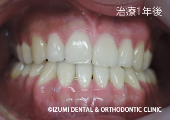 治療1年後
