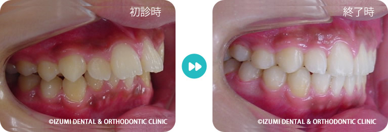 初診時～矯正治療終了時