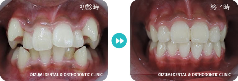 治療前・治療後