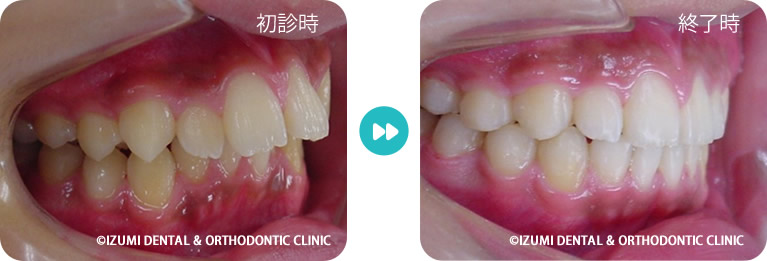 非抜歯矯正の効果