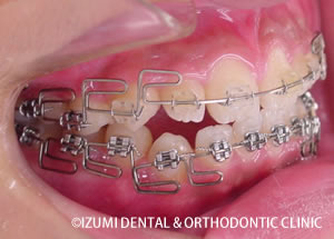 MEAW（マルチループ）