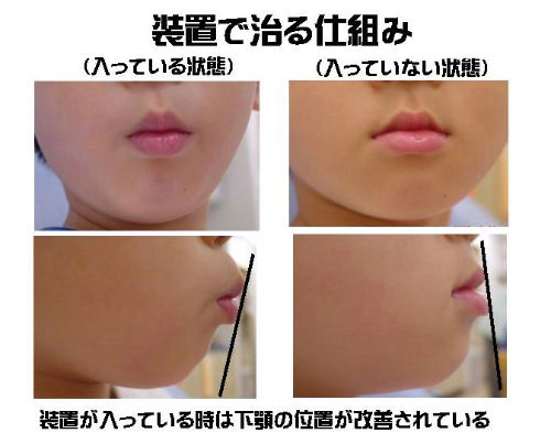 受け口はどう治すの(3歳からの矯正治療)_copy.jpg