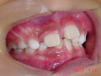 060728　teeth side cut_copy.jpg