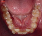 s-070216　lower teeth cut.jpg