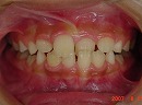 s-070811 whole teeth cut.jpg