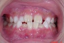 s-080617 whole teeth cut.jpg