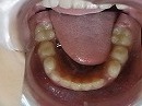 s-101111 lower teeth.jpg