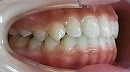 s-110528 teeth side cut.jpg
