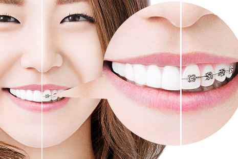 インビザライン装置比較
