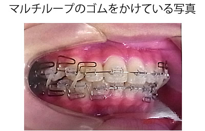 マルチループのゴムをかけている写真