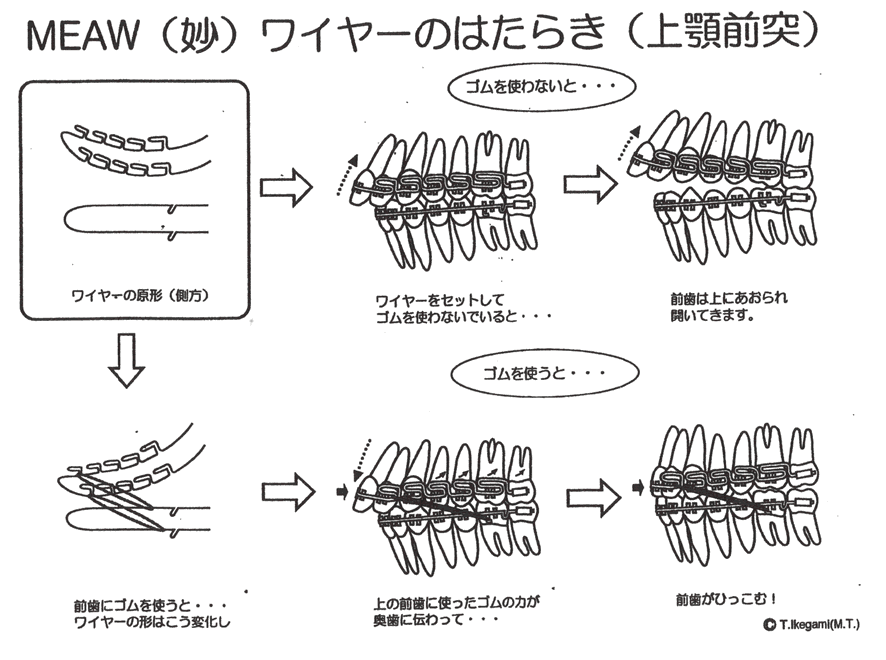 MEAWワイヤーの働き（上顎前突）