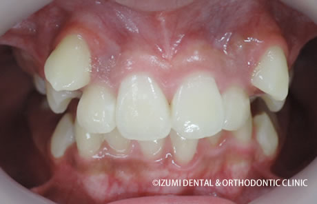 １年後八重歯
