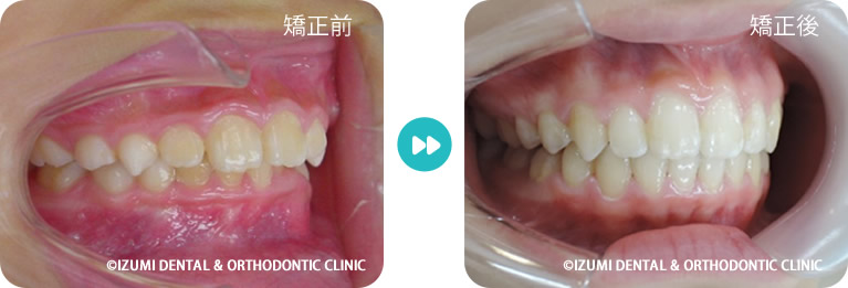 深い咬み合わせ