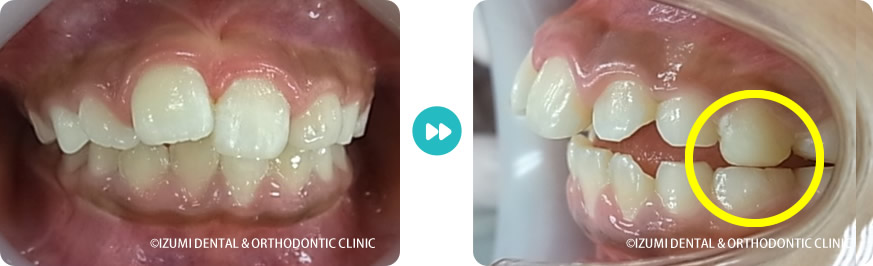 こどもの歯並びが悪い症例