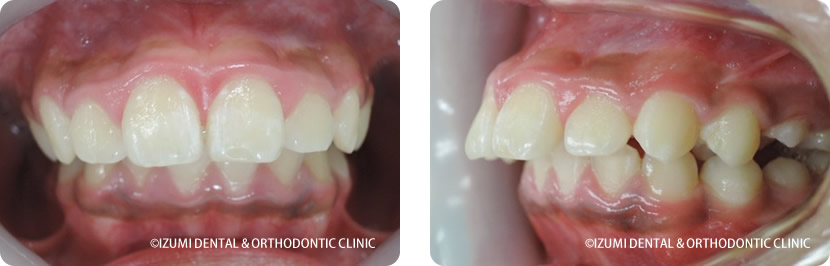 初診時11歳８か月