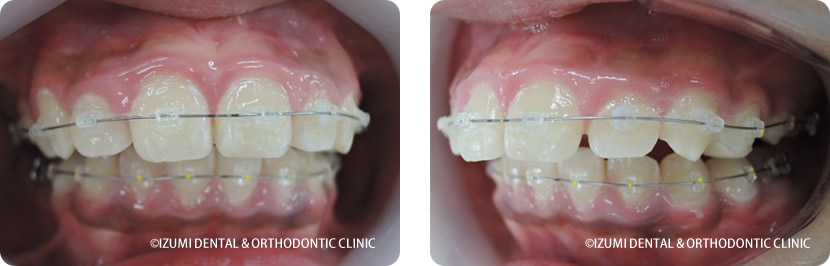 見えにくいブラケット