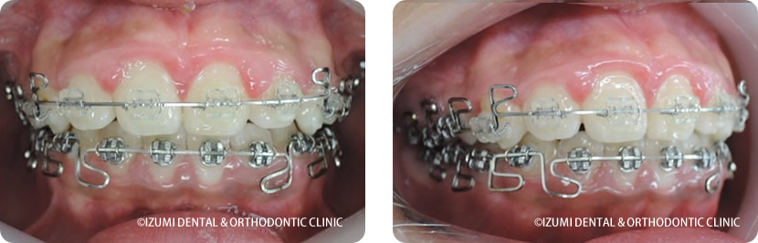 マルチループ1年後