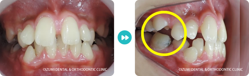 10歳９カ月子ども歯並び