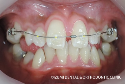 矯正装置を装着