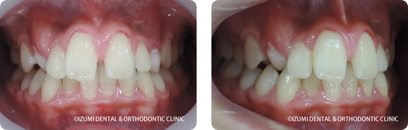 初診時12歳2か月
