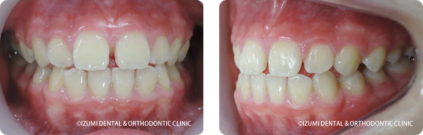 治療前１０歳４ヶ月