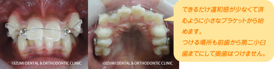 ブラケット矯正装置