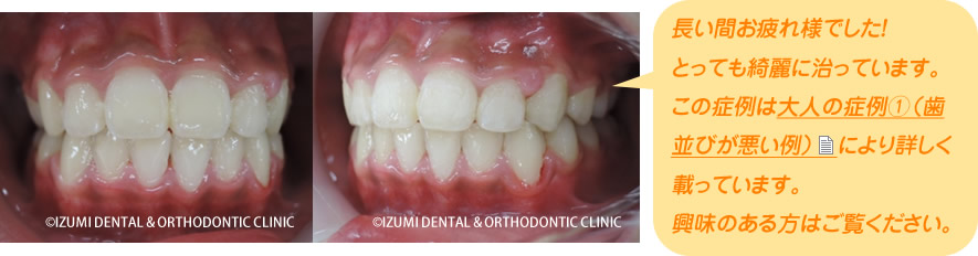 歯並びが悪い例