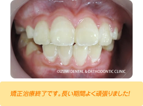 矯正治療終了です。長い期間よく頑張りました！