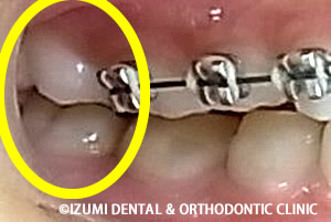 第一大臼歯の咬み合い