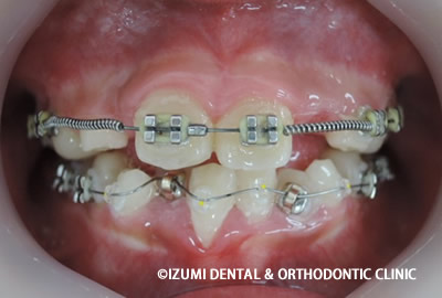 下額に矯正装置