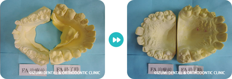 治療前後の模型比較