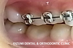 第一大臼歯の咬み合い