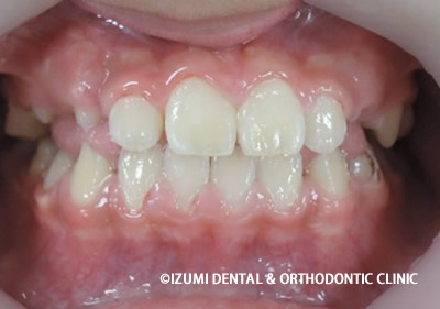 矯正治療終了時