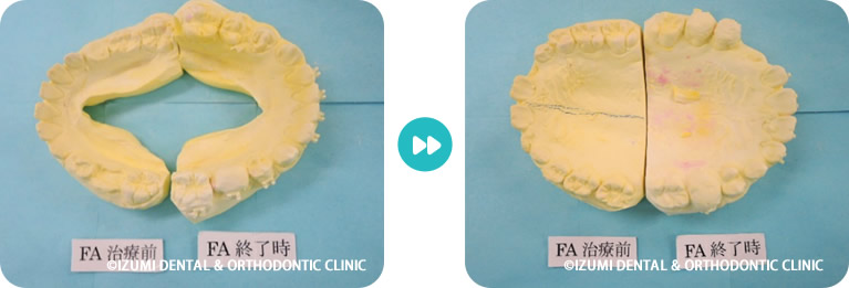 こどもの反対咬合模型比較