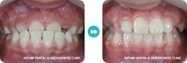 こどもの反対咬合術前術後
