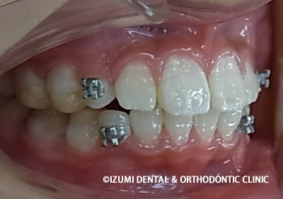 矯正治療終了時