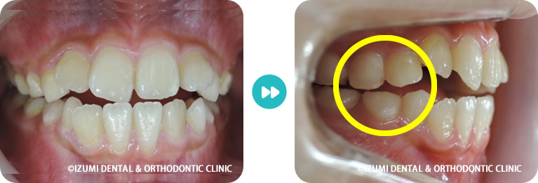 子どもの開咬9歳