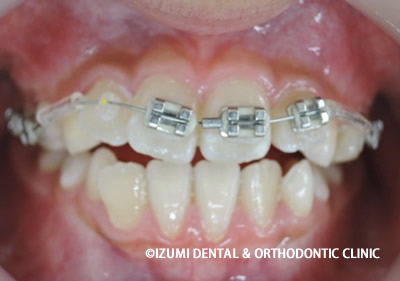 こどもの開咬装置上顎