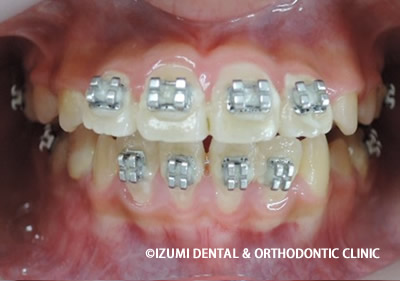 こどもの開咬ブラケット下顎