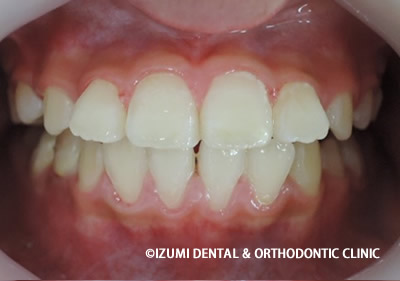 こどもの開咬終了