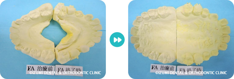 こどもの開咬模型