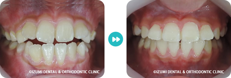 こどもの開咬術前術後