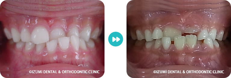 顎が曲がっている子ども症例4～7歳