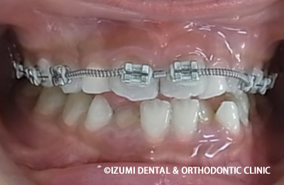 矯正装置を装着