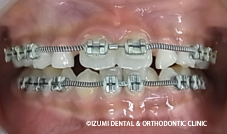 下額に矯正装ブラケット
