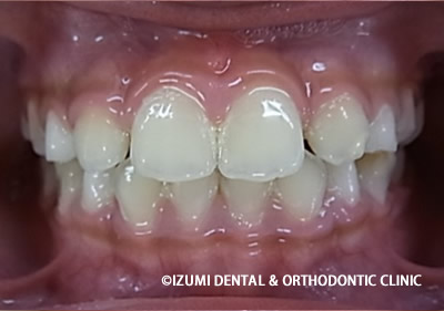 治療終了1年6か月後
