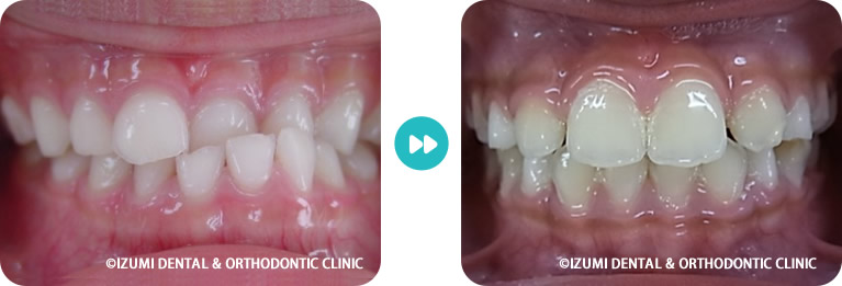 顎が曲がっている子ども術前術後