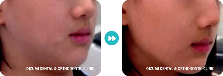 受け口(下顎前突)の口元変化